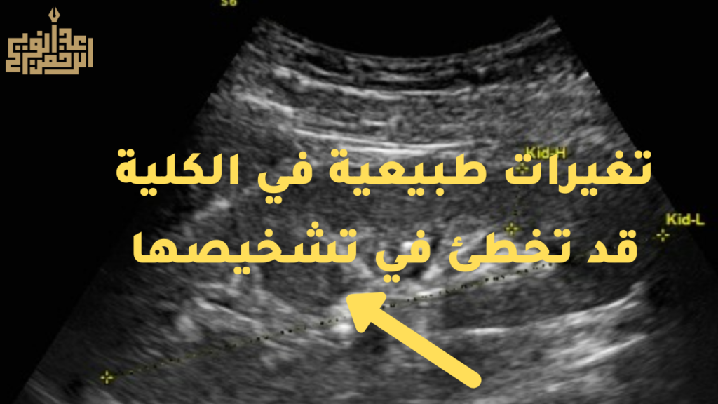تغيرات كلية ألتراساوند